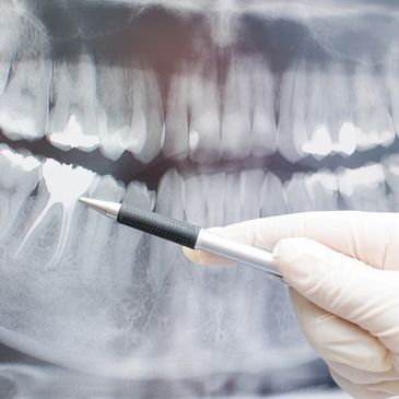 Fort Myers dentist Tooth Extraction Cleaning x-rays